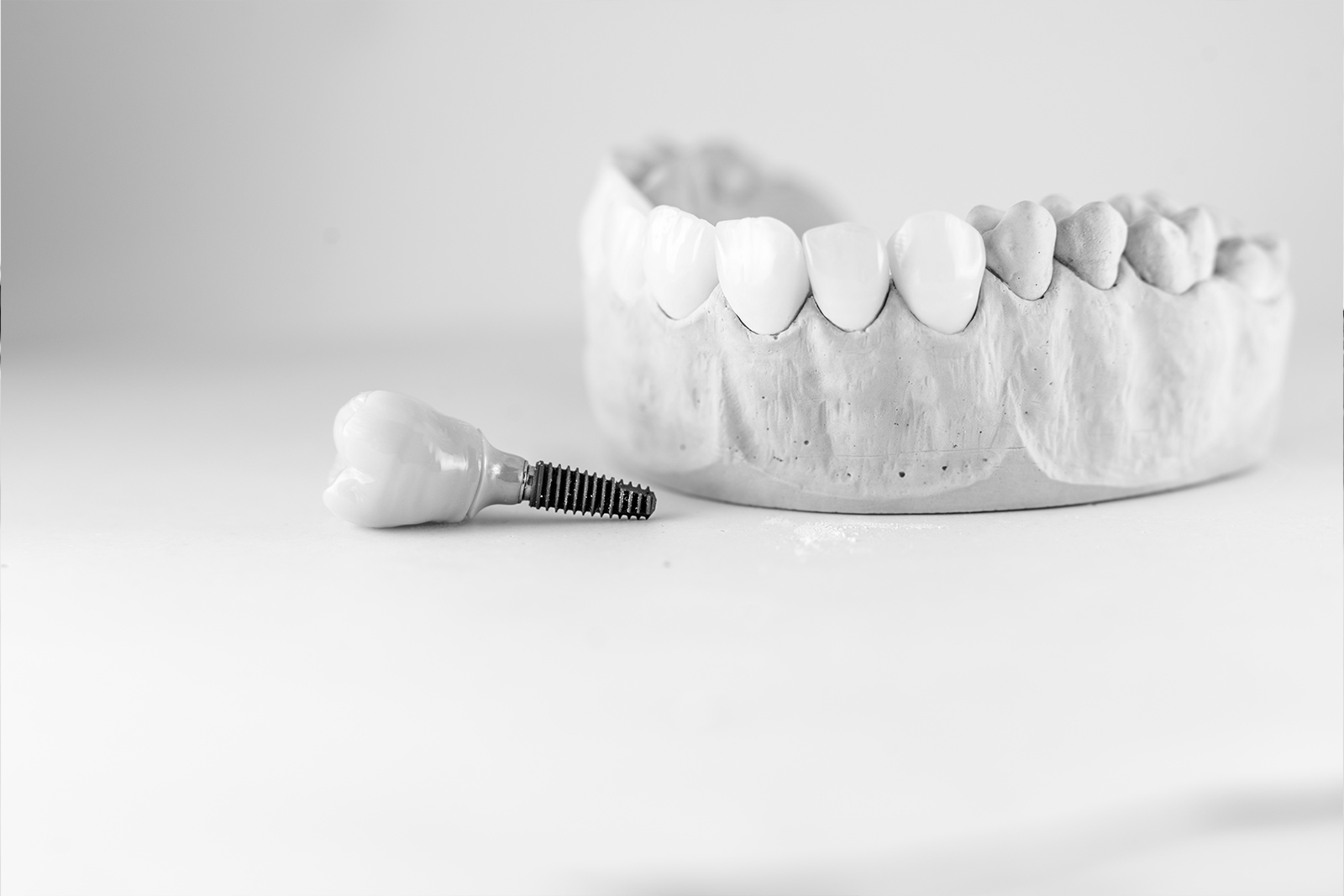 ¿Cómo funciona la cirugía guiada dental?