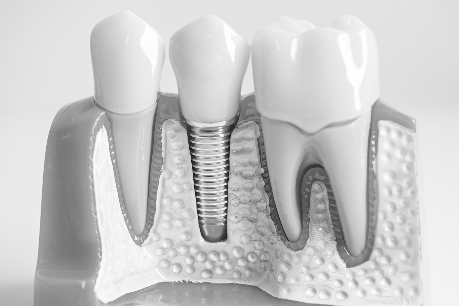 ¿Los implantes dentales son dolorosos?